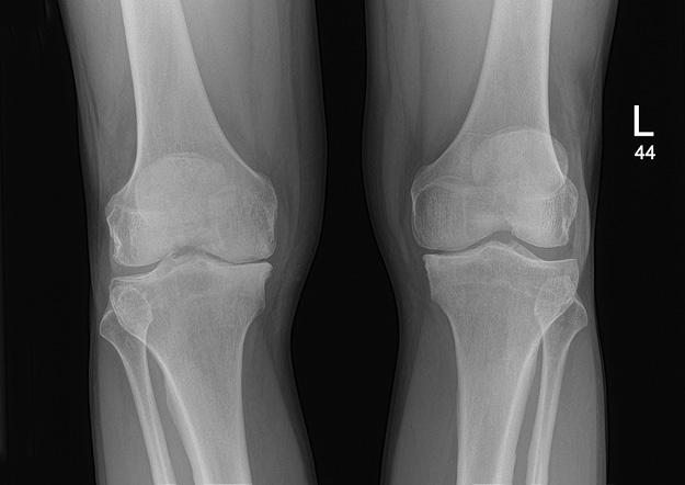 Gavin's Partial Knee Replacement Case Study | Mr Nirav Shah