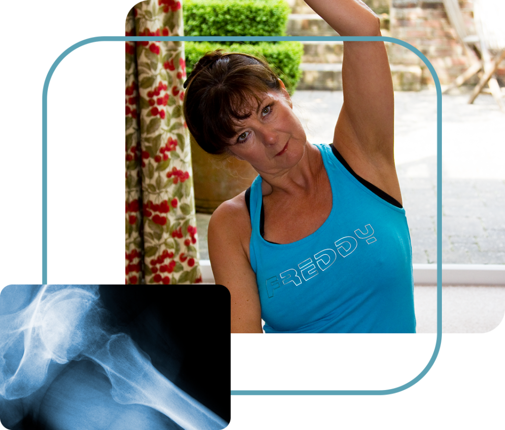 Jo's hip replacement case study
