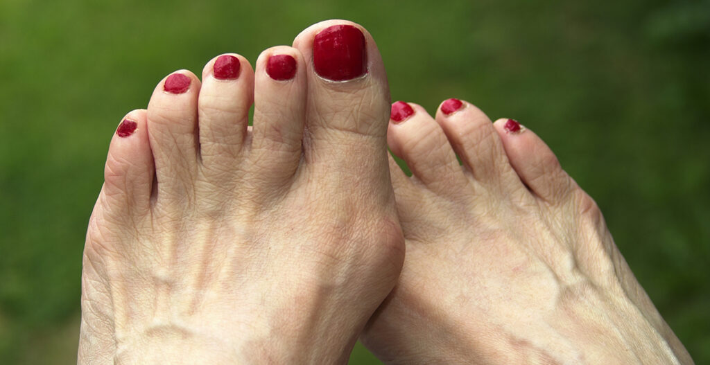 Bunion treatment in Sussex