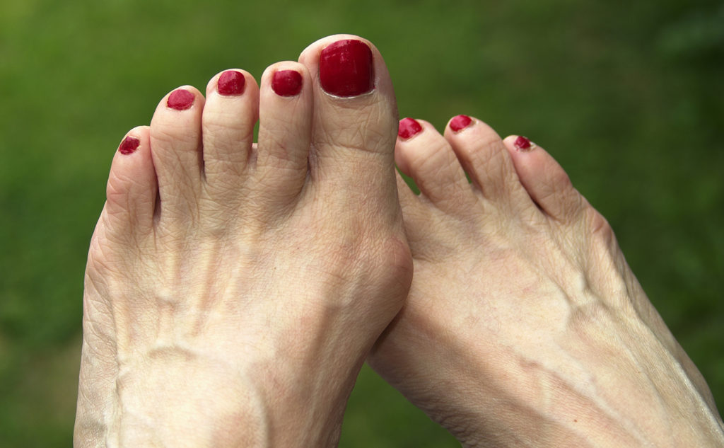 Bunion treatment in Sussex